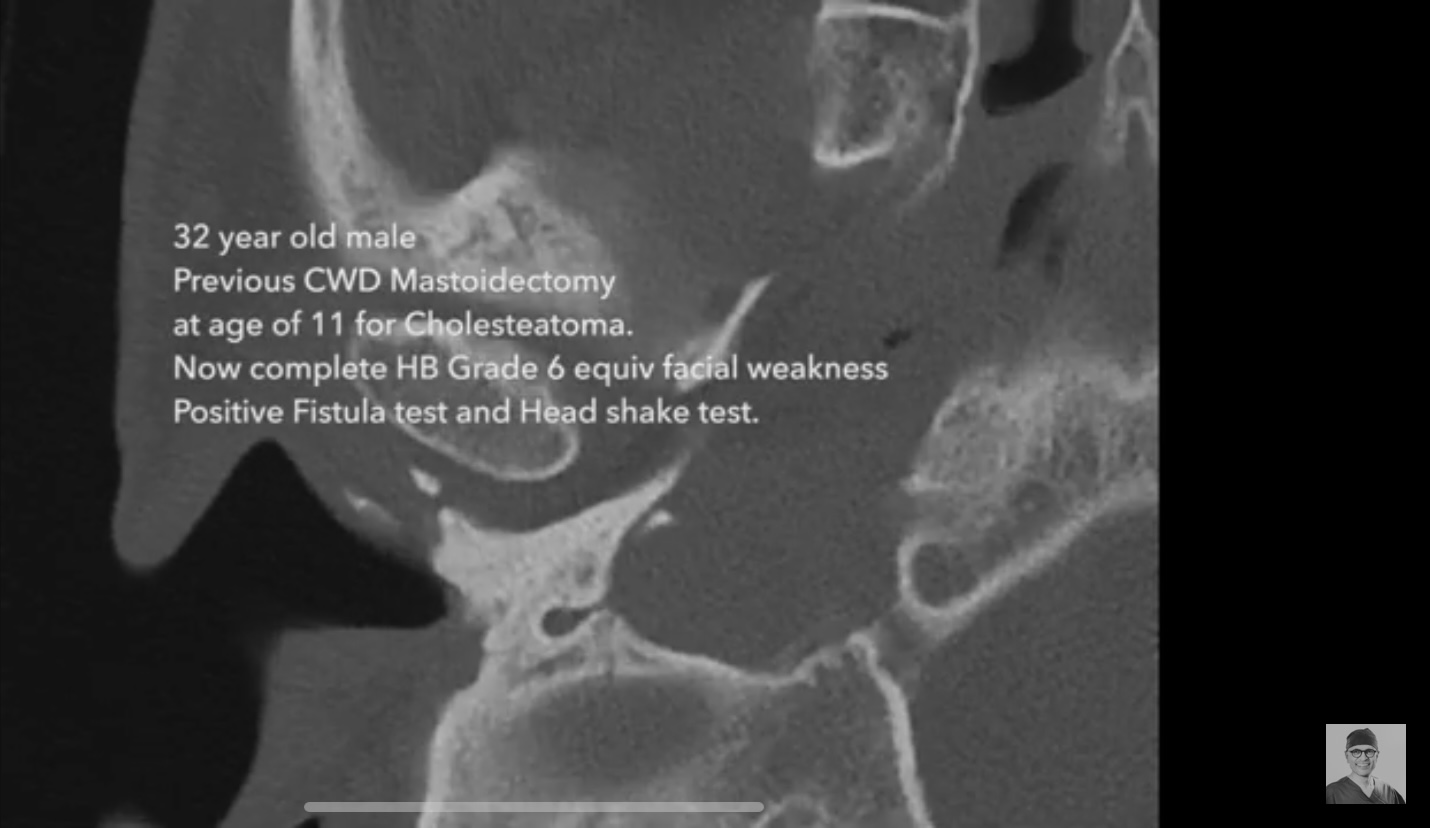 Colesteatoma, parálisis facial y fístula laberíntica