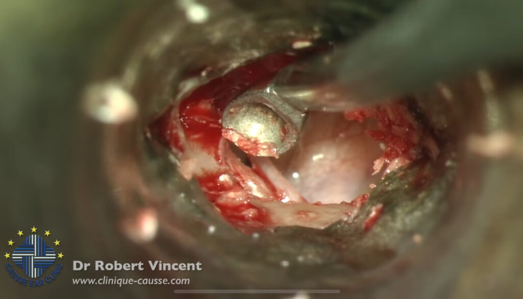 Cirugía primaria por otosclerosis