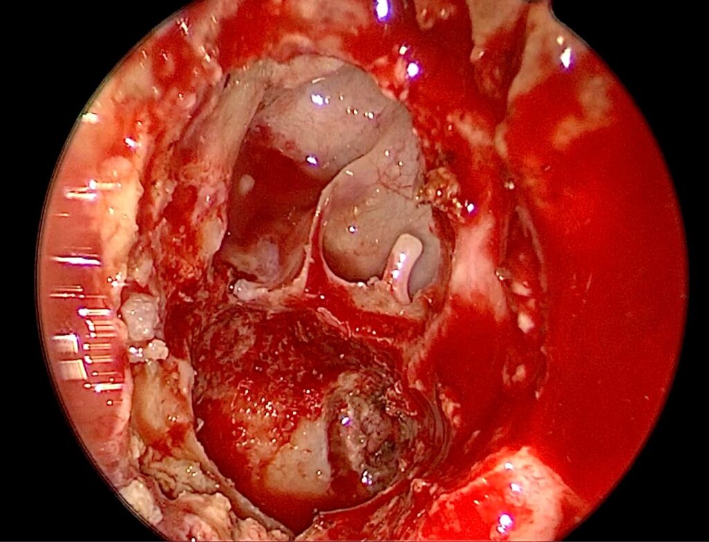 Extirpación de granuloma del ápice petroso