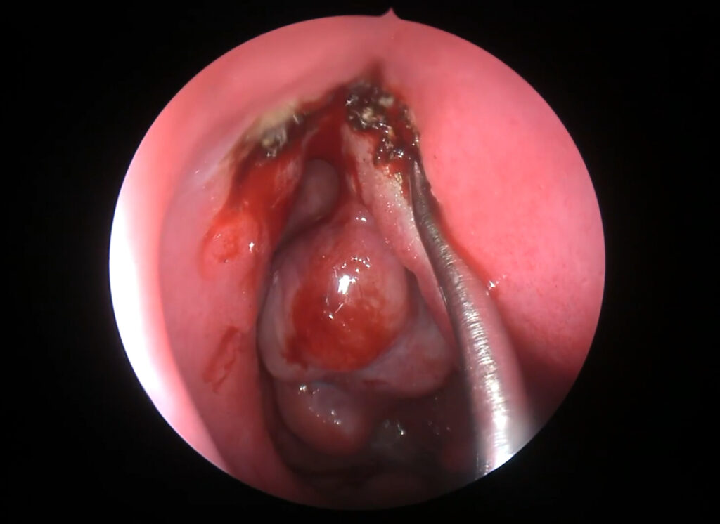 Schwannoma nasal