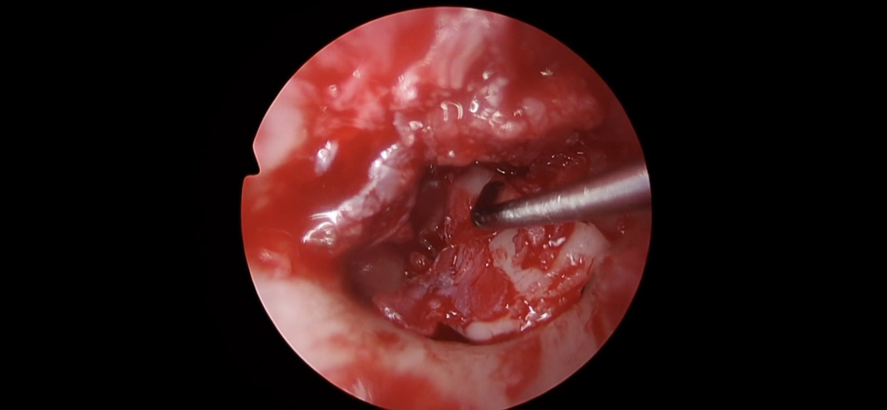 colesteatoma con facial dehiscente