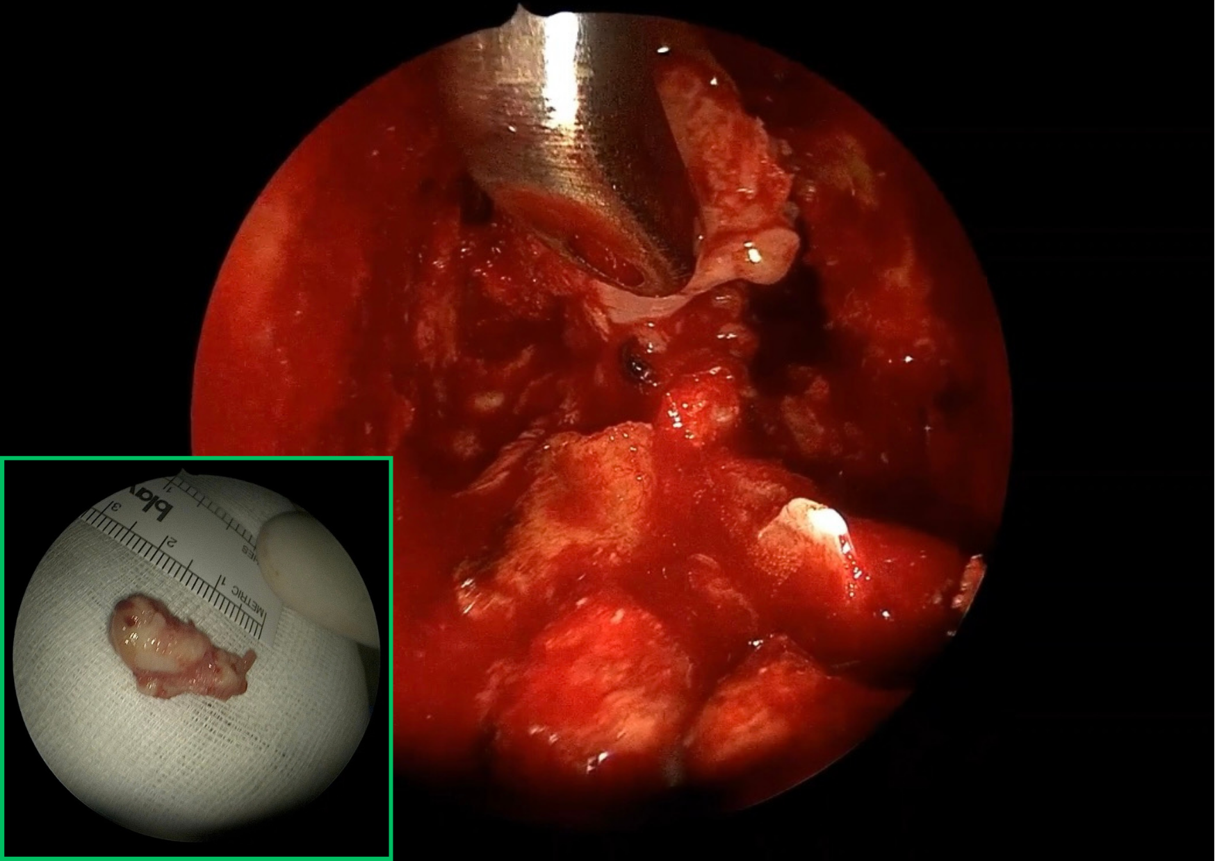 Osteoma frontal gigante