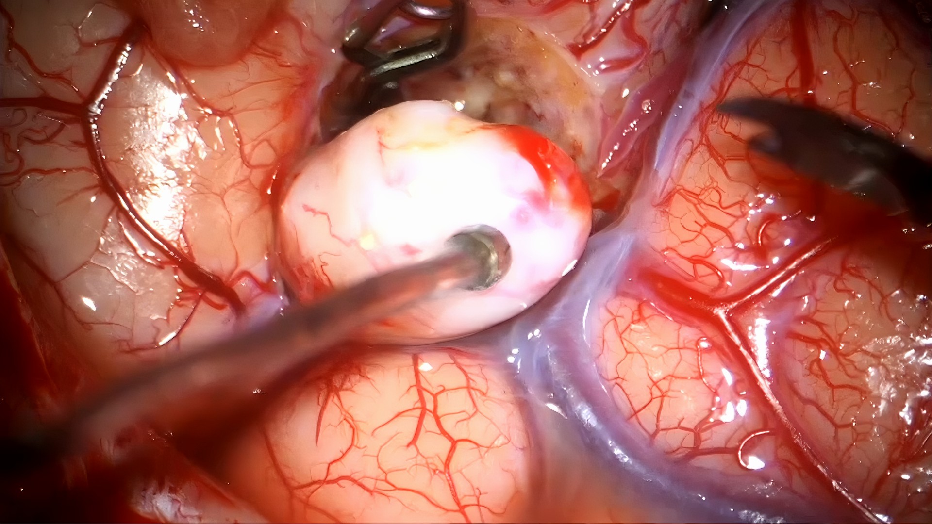 El Dr. Ibáñez realiza una cirugía compleja para la extirpación de un aneurisma distal en la arteria cerebral media izquierda de un niño.