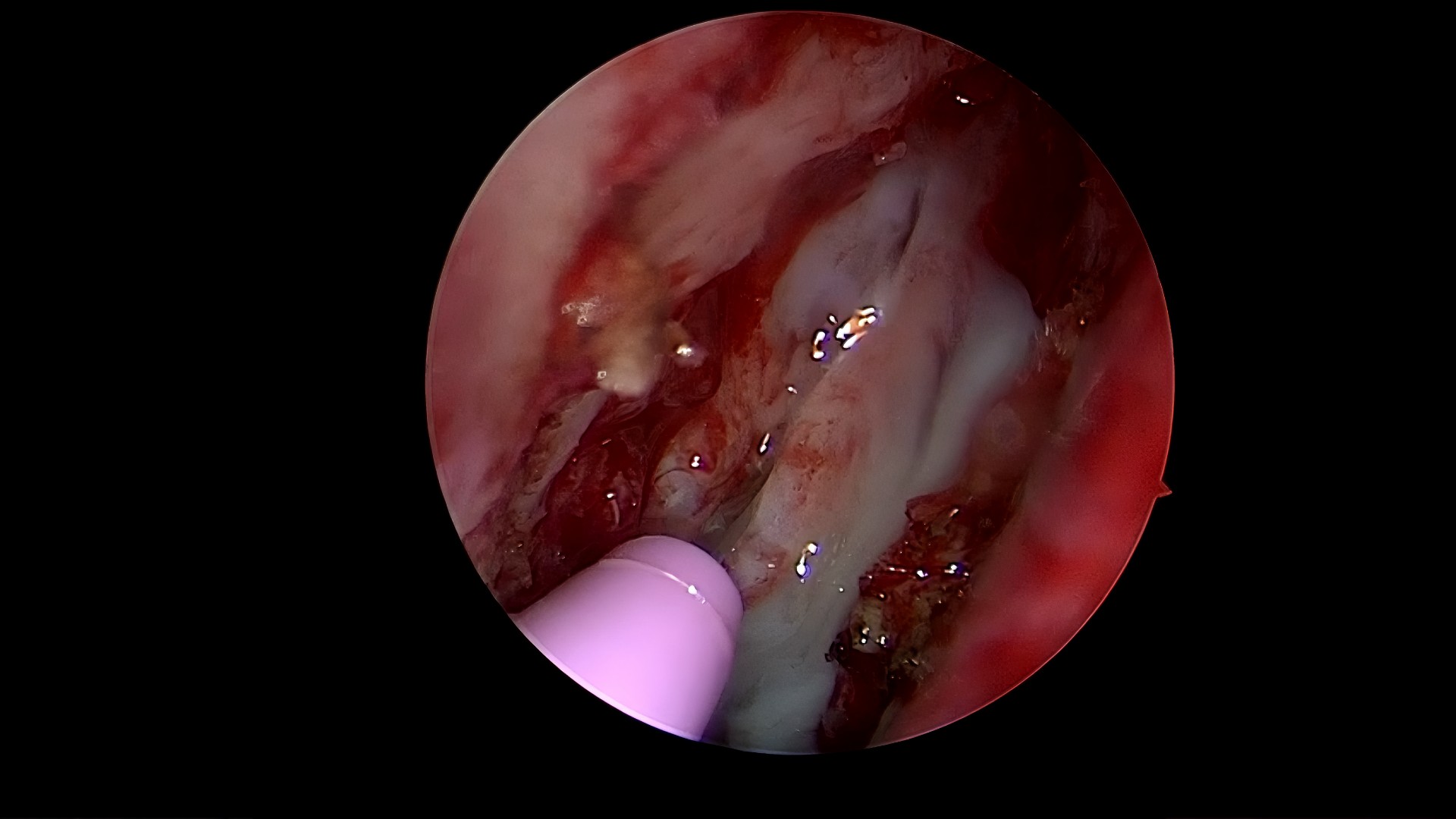 El Dr. Echaide muestra paso a paso la resolución endoscópica de la patología obstructiva baja de la vía lagrimal, dacriocistorrinostomía.