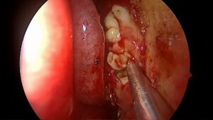 El Dr Cristobal Langdon realiza una cirugía para eliminar un mucocele etmoidal pediátrico, un quiste benigno que causaba obstrucción sinusal.