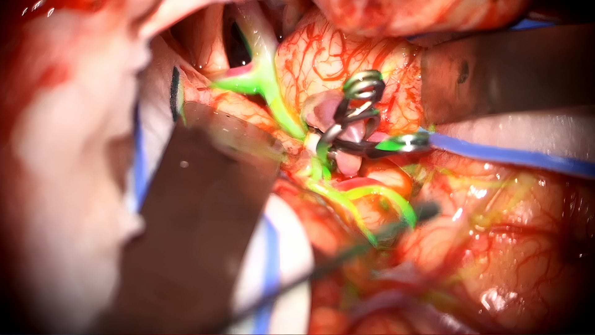 adenoma no funcionante MiPlatta.