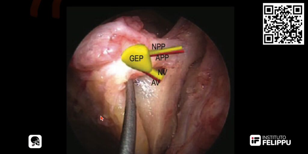 Epistaxis