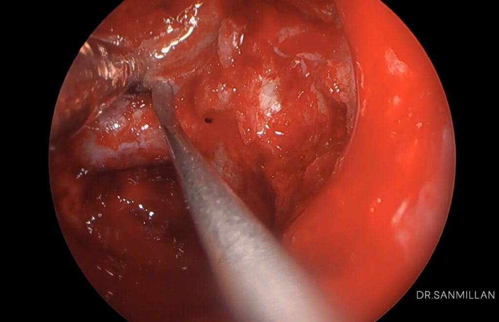 meningioma tuberculum selar