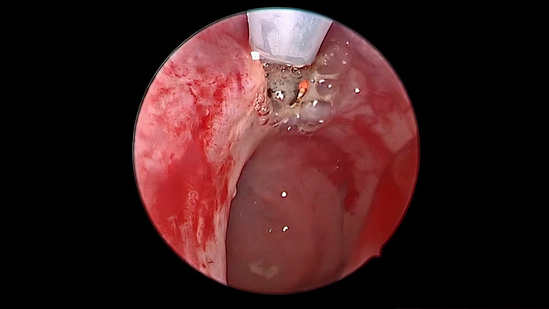 Atresia coanal unilateral