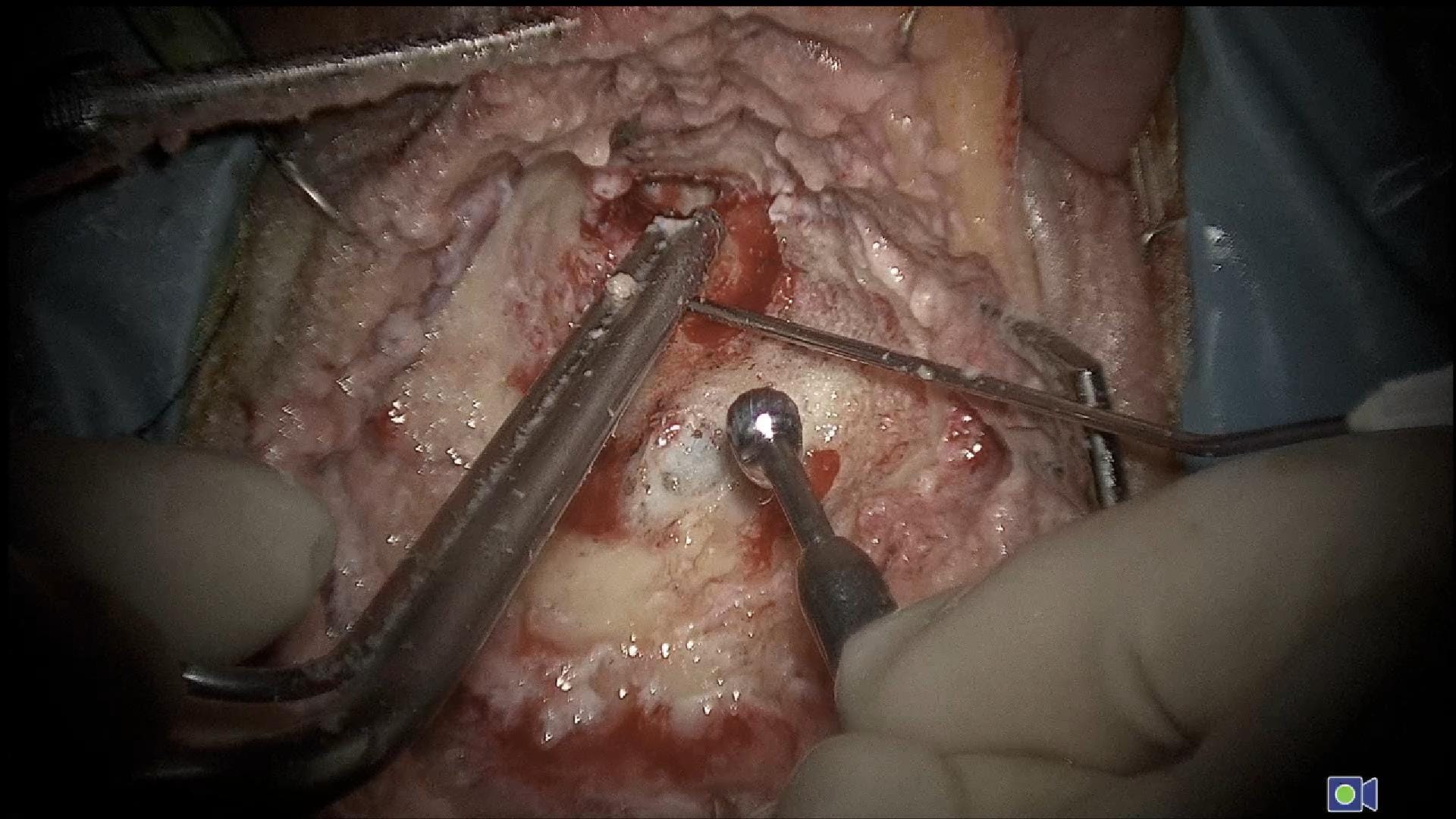 Técnica de fresado mastoidectomía abierta.