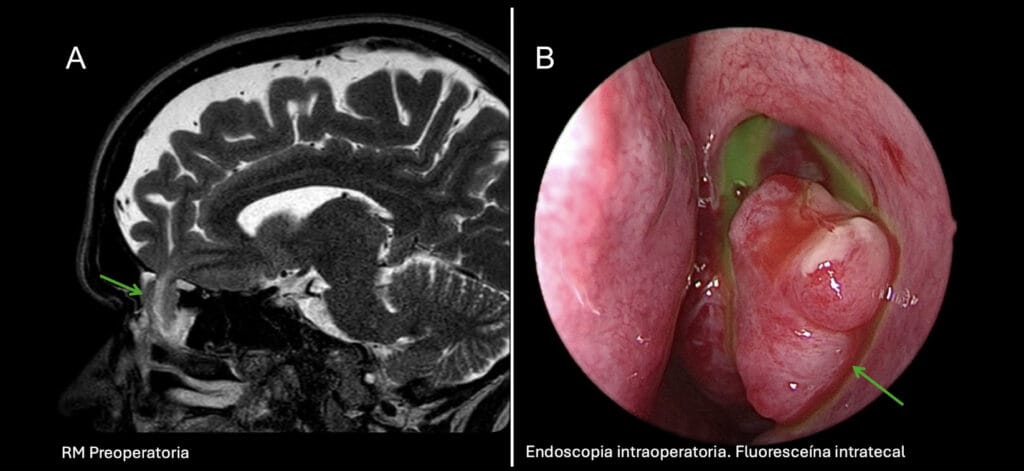 Meningoencefalocele transetmoidal izquierdo