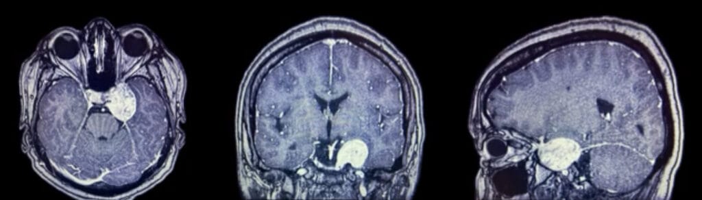 tumor seno cavernoso