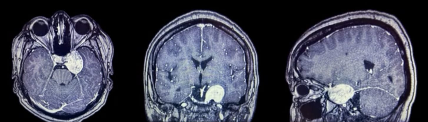 tumor seno cavernoso