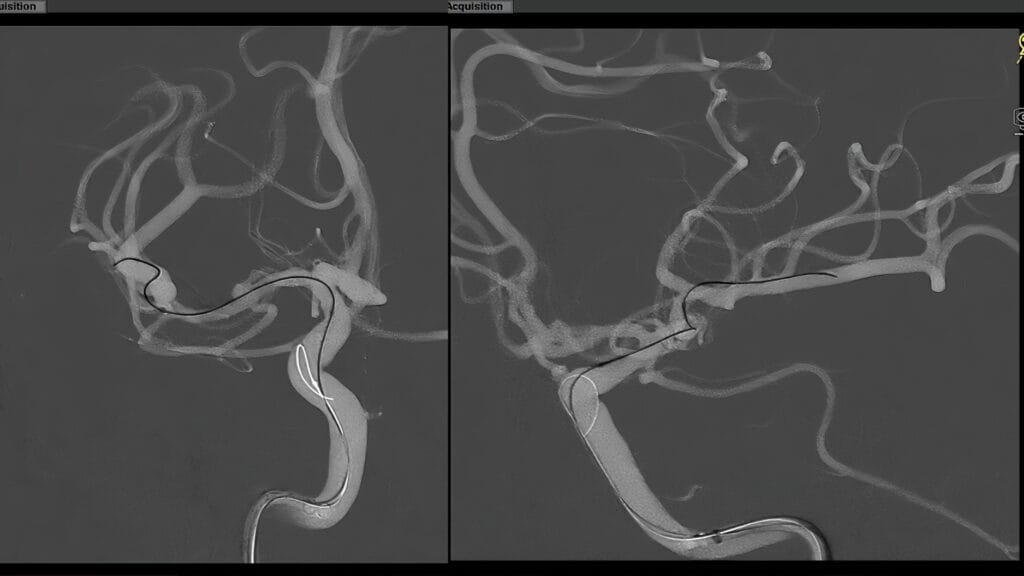 El Dr. JaeHyun Shim realiza una embolización con coils asistida por stent para tratar un aneurisma no roto de M1 derecho.