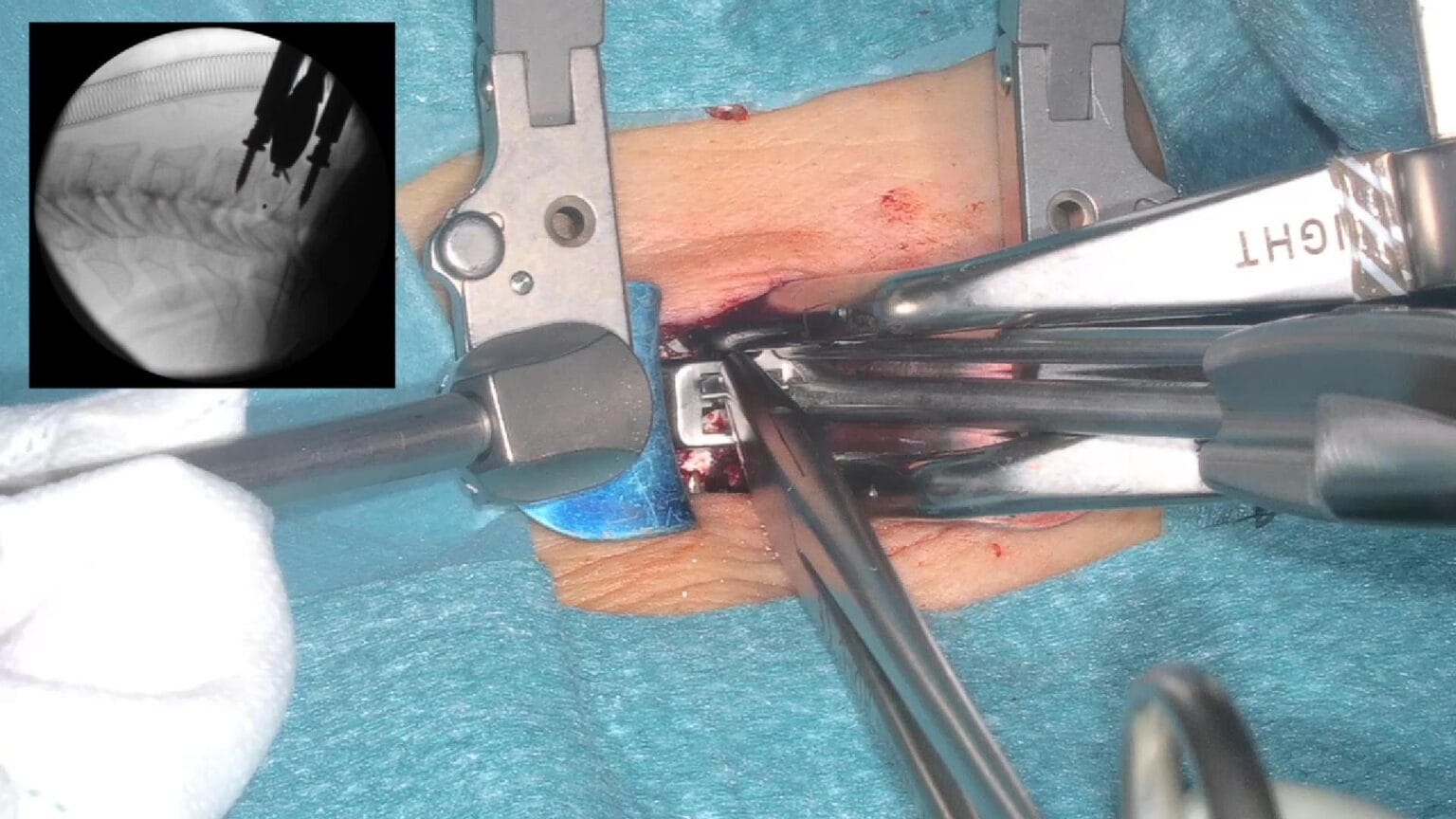 Discectomía cervical C6-C7 con atrodesis