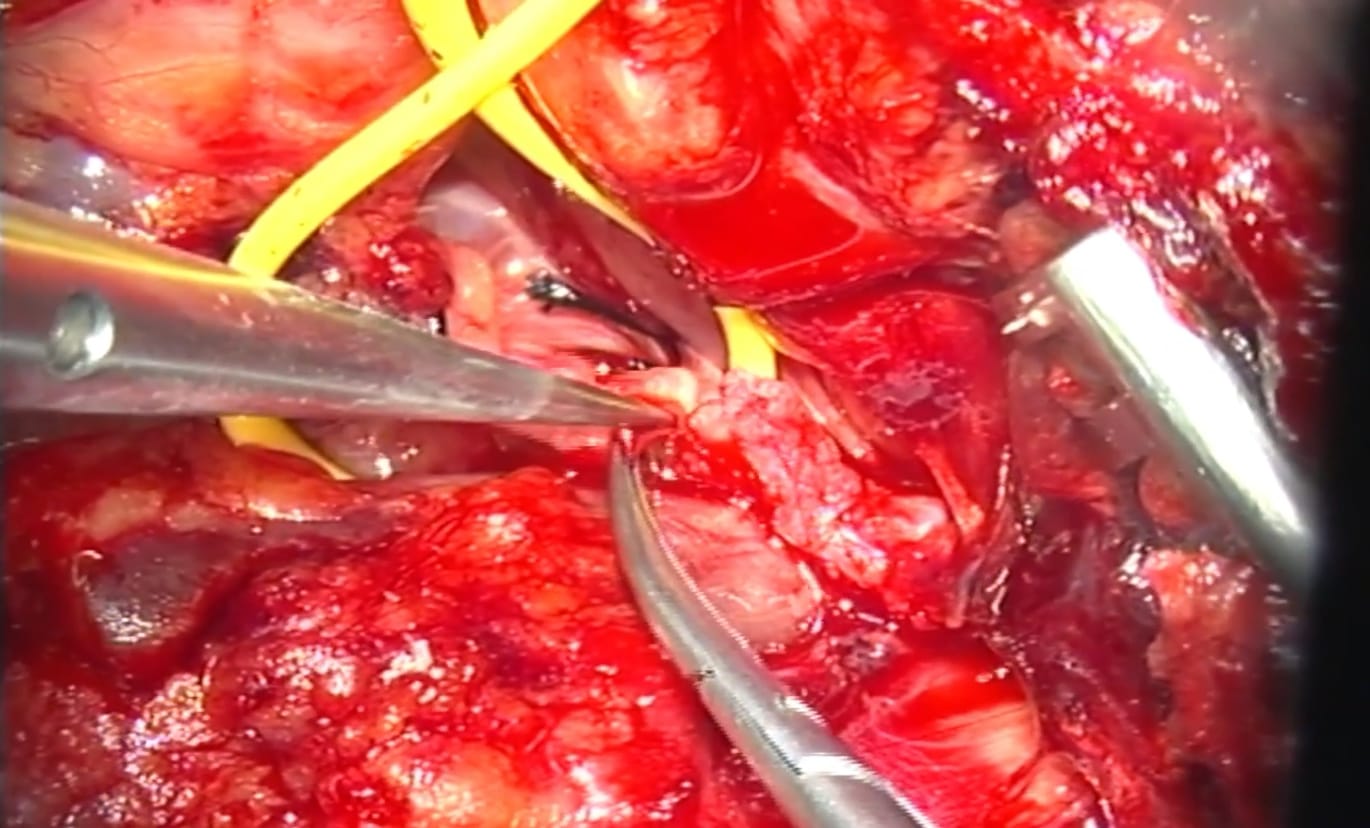 Conexión hipogloso-facial término lateral