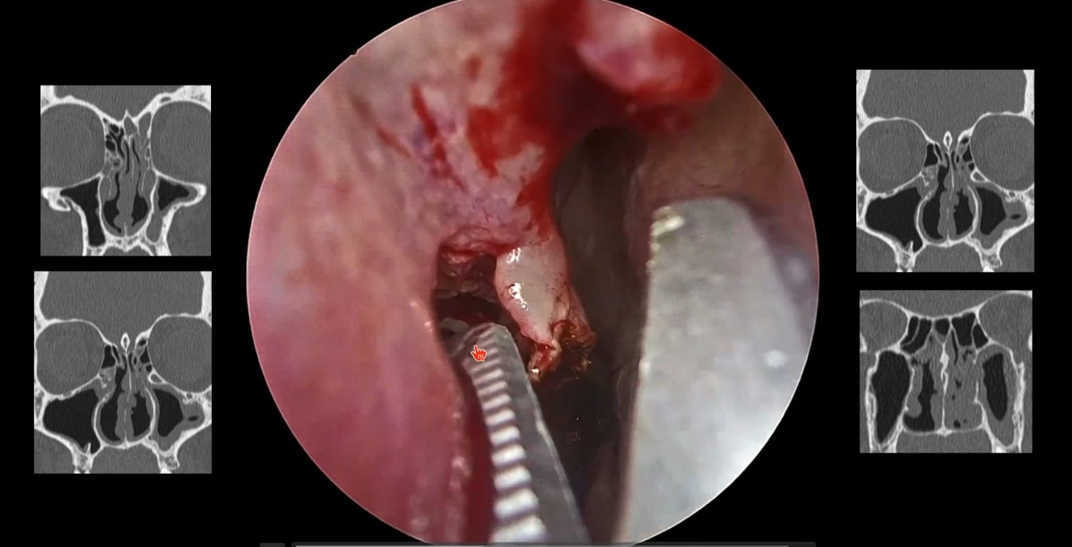 El Dr. Felippu aborda 3 casos de recirculación del seno maxilar, destacando la importancia de una uncinectomía adecuada.