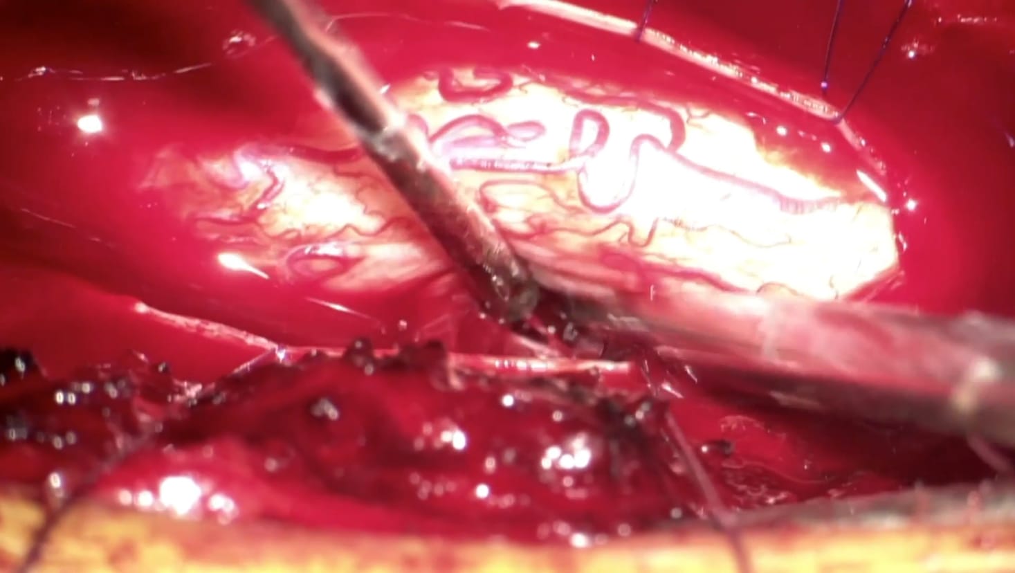 Schwannoma dorsal