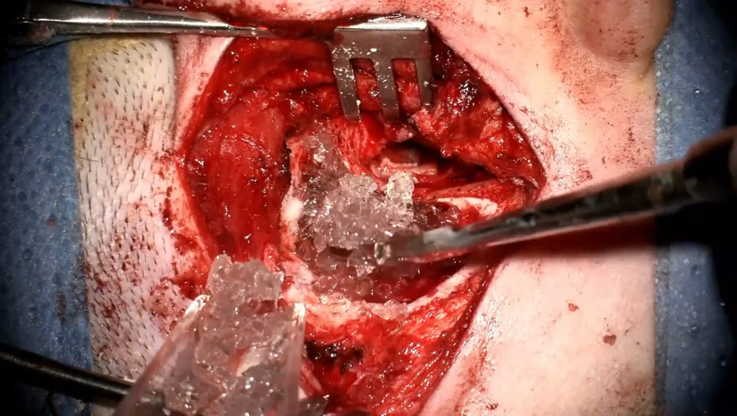 Timpanoplastia y mastoidectomía cerrada