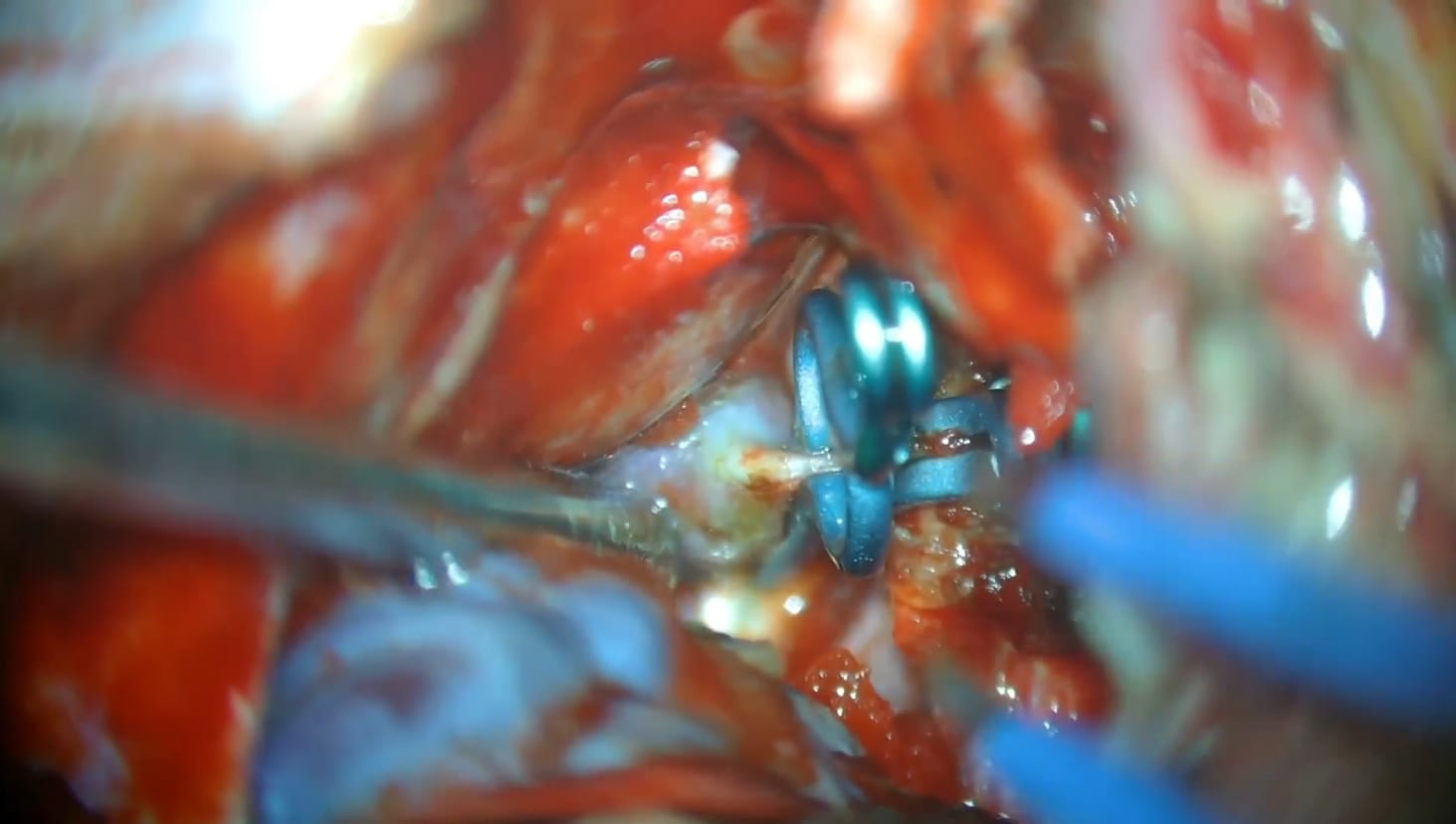 carotid-ophthalmic aneurysm