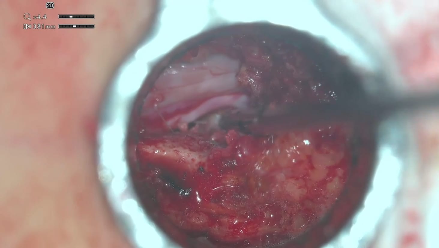 L5-S1 microdiscectomy