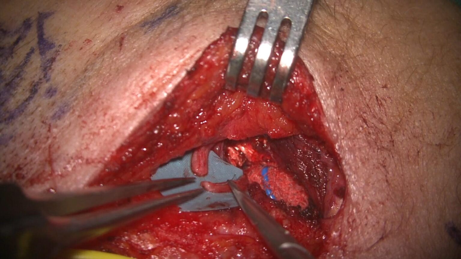 facial-masseteric