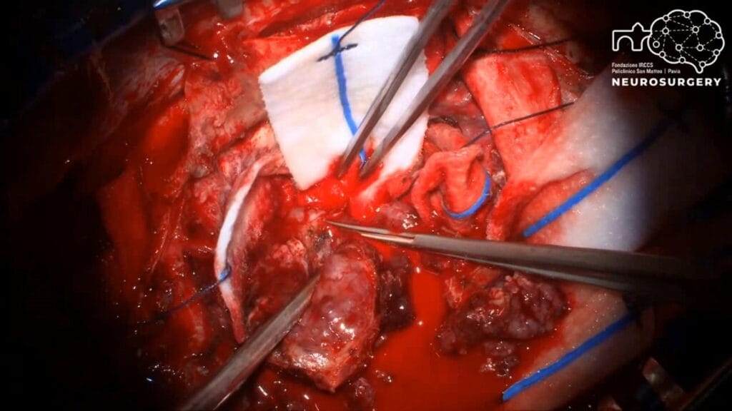 meningioma convexidad