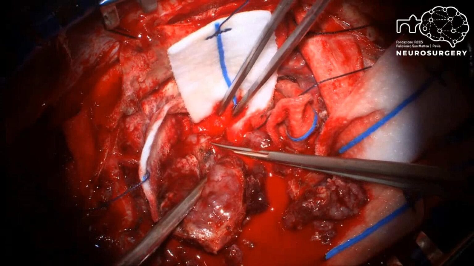 convexity meningioma