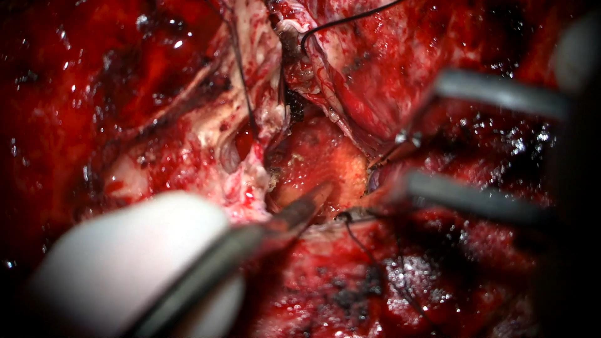 Abordaje Transpetroso Combinado