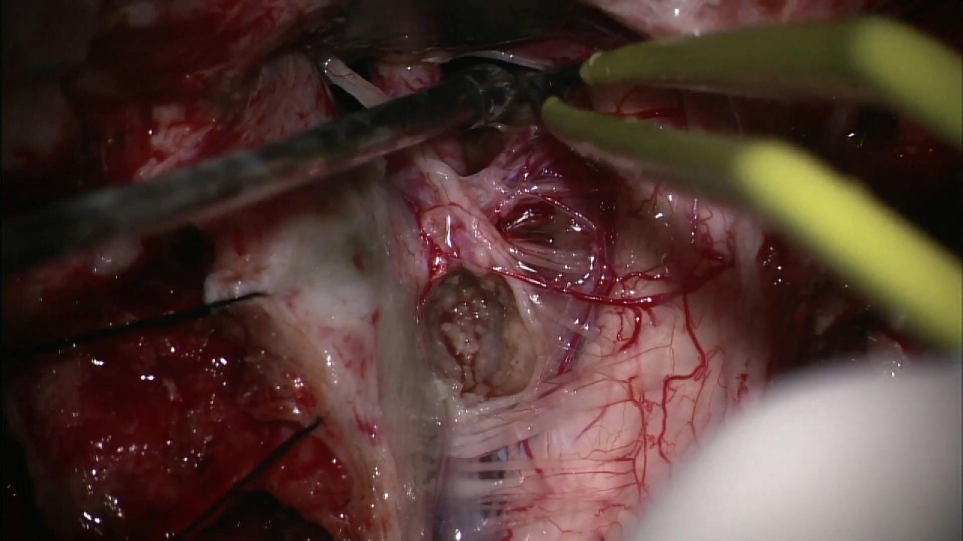 El Dr. Rubino realiza una resección completa de un meningioma anterior del foramen magno mediante abordaje far lateral.