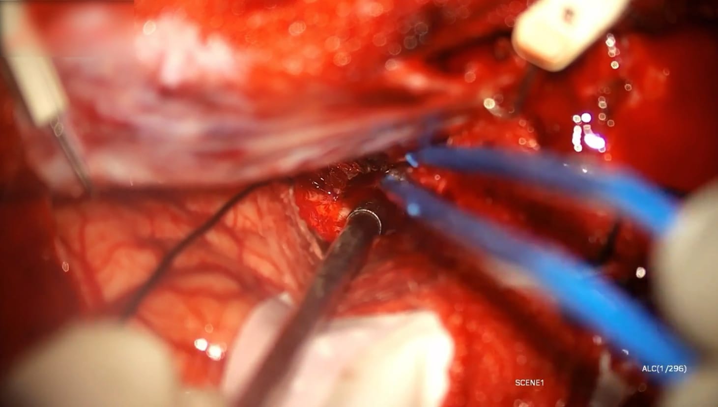 Craneotomía pterional para Meningioma del tubérculo selar