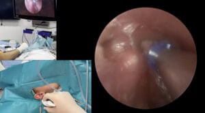 Drenaje transtimpánico endoscópico pediátrico