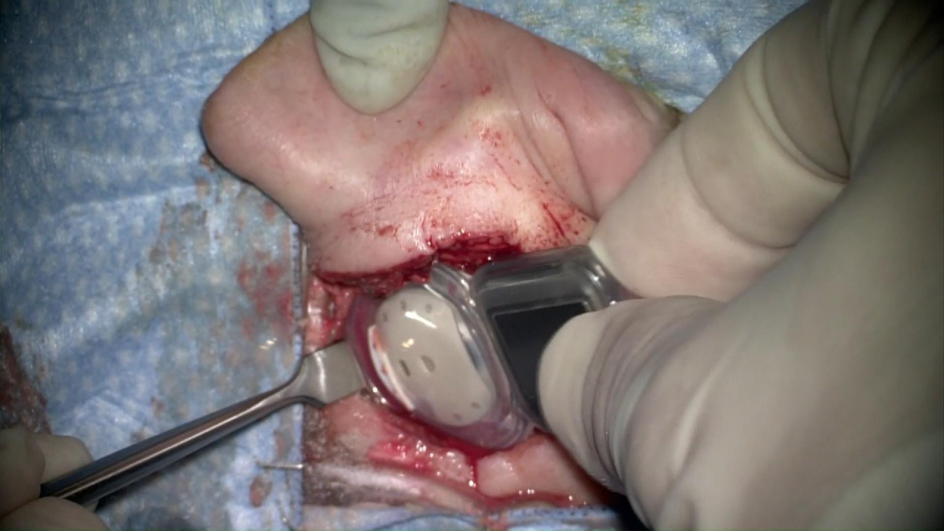 Implante coclear derecho