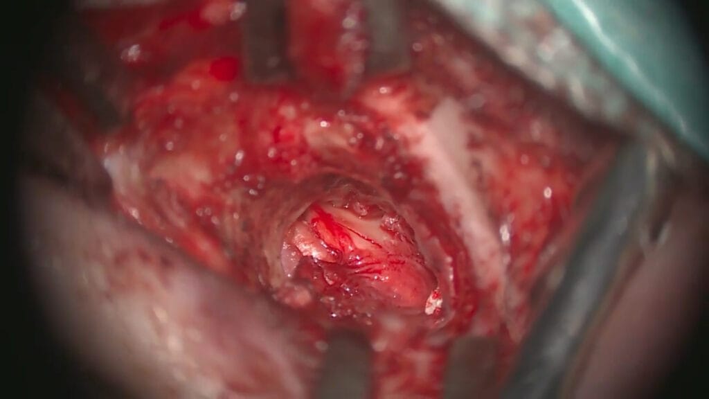 Colesteatoma abordaje combinado