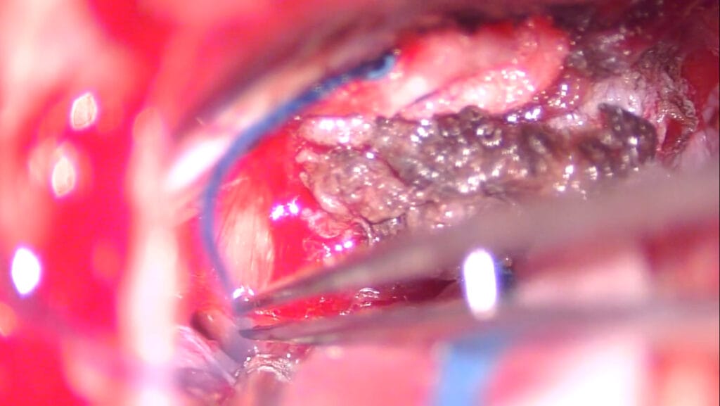 meningioma ángulo pontocerebeloso