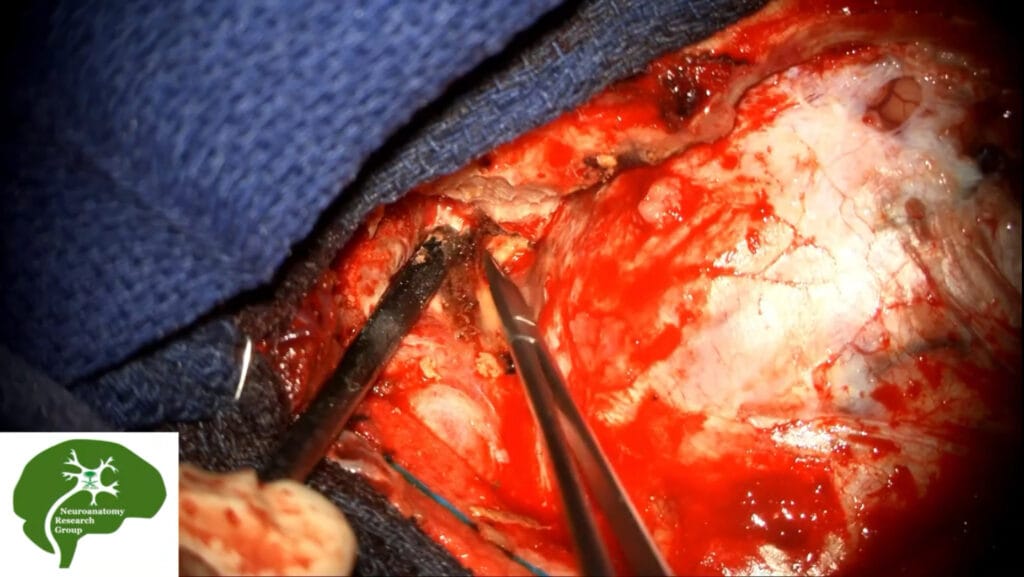 meningioma del planum esfenoidal