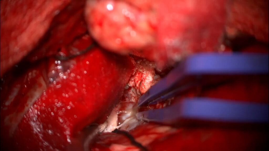 meningioma clinoideo anterior