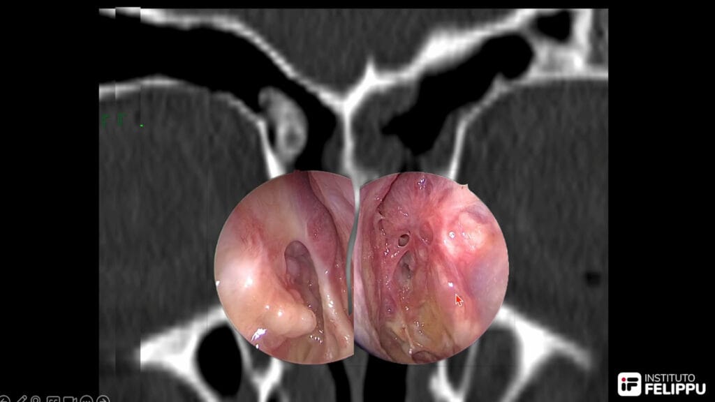 reoperaciones seno frontal