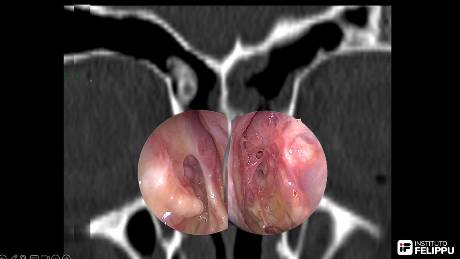 reoperaciones seno frontal