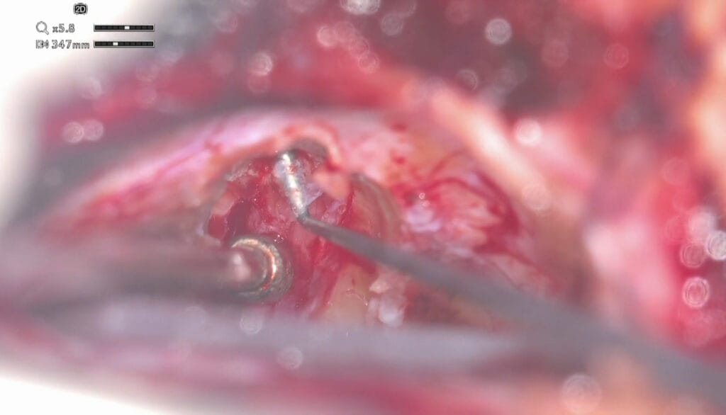 Schwannoma vestibular