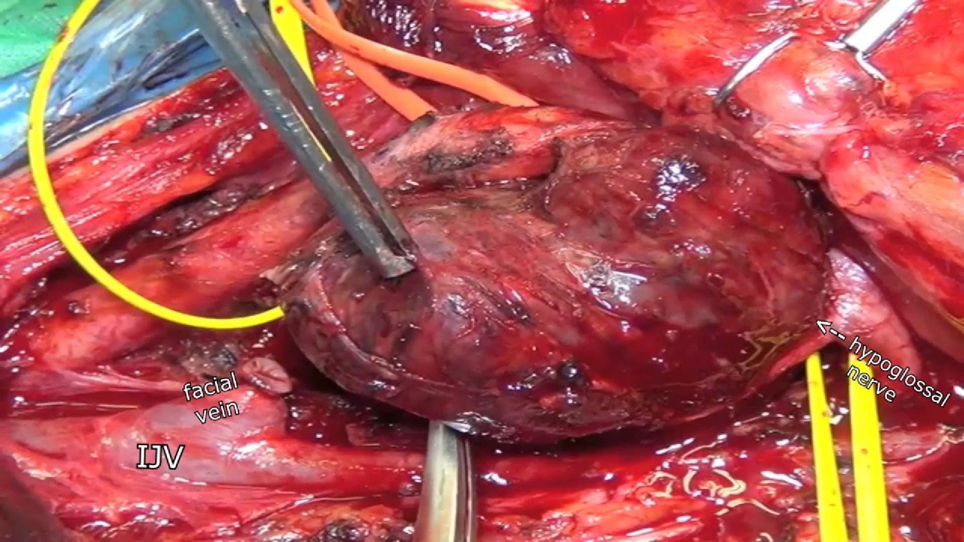 Multiple giant glomus tumors