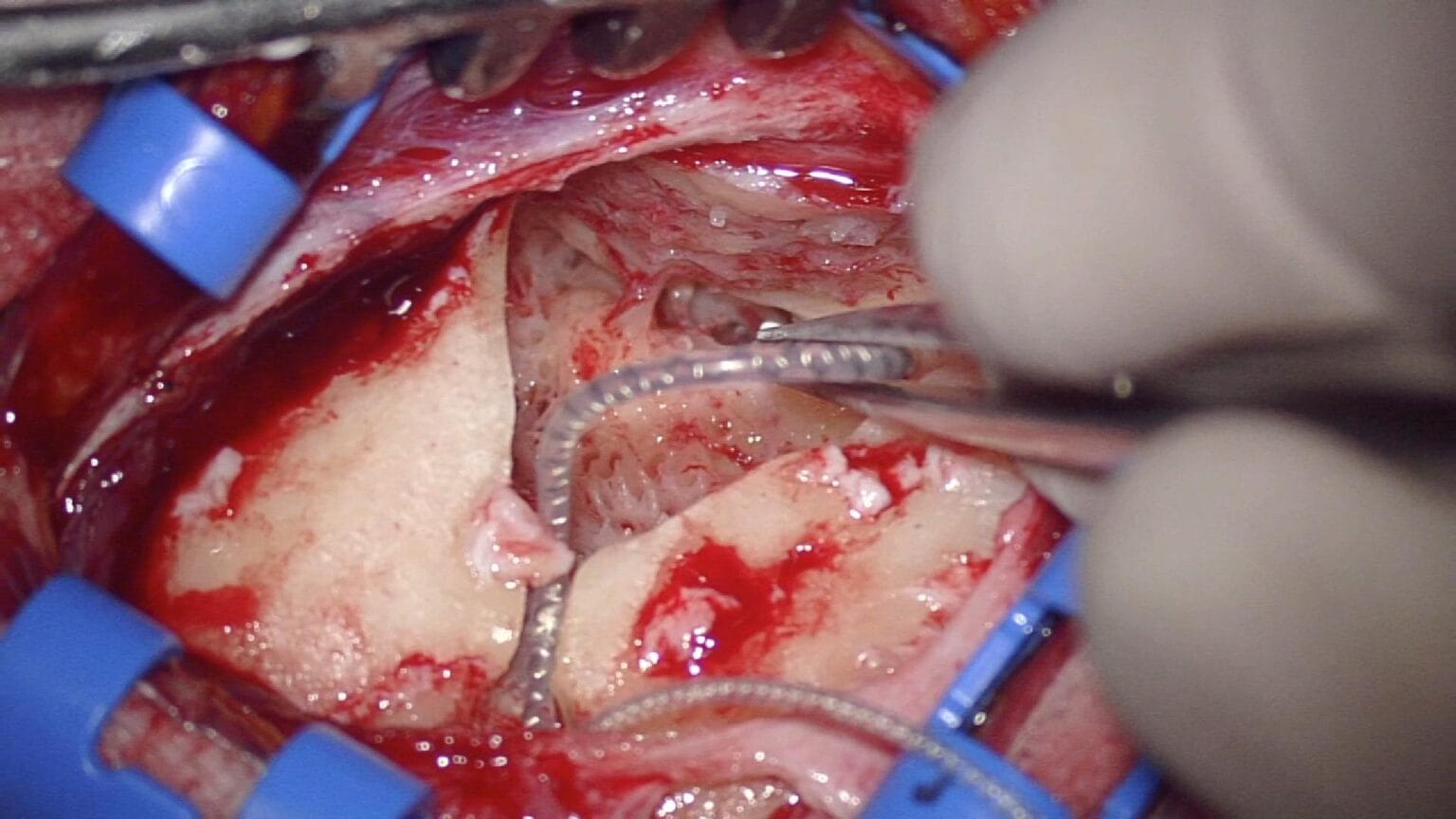Cochlear Implantation - Slim Perimodiolar Electrod