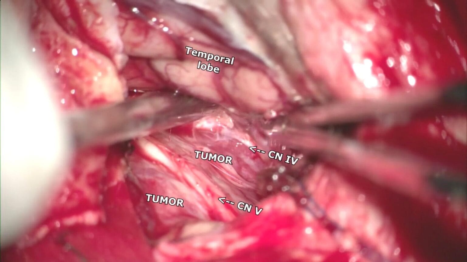 Giant Petroclival Meningioma
