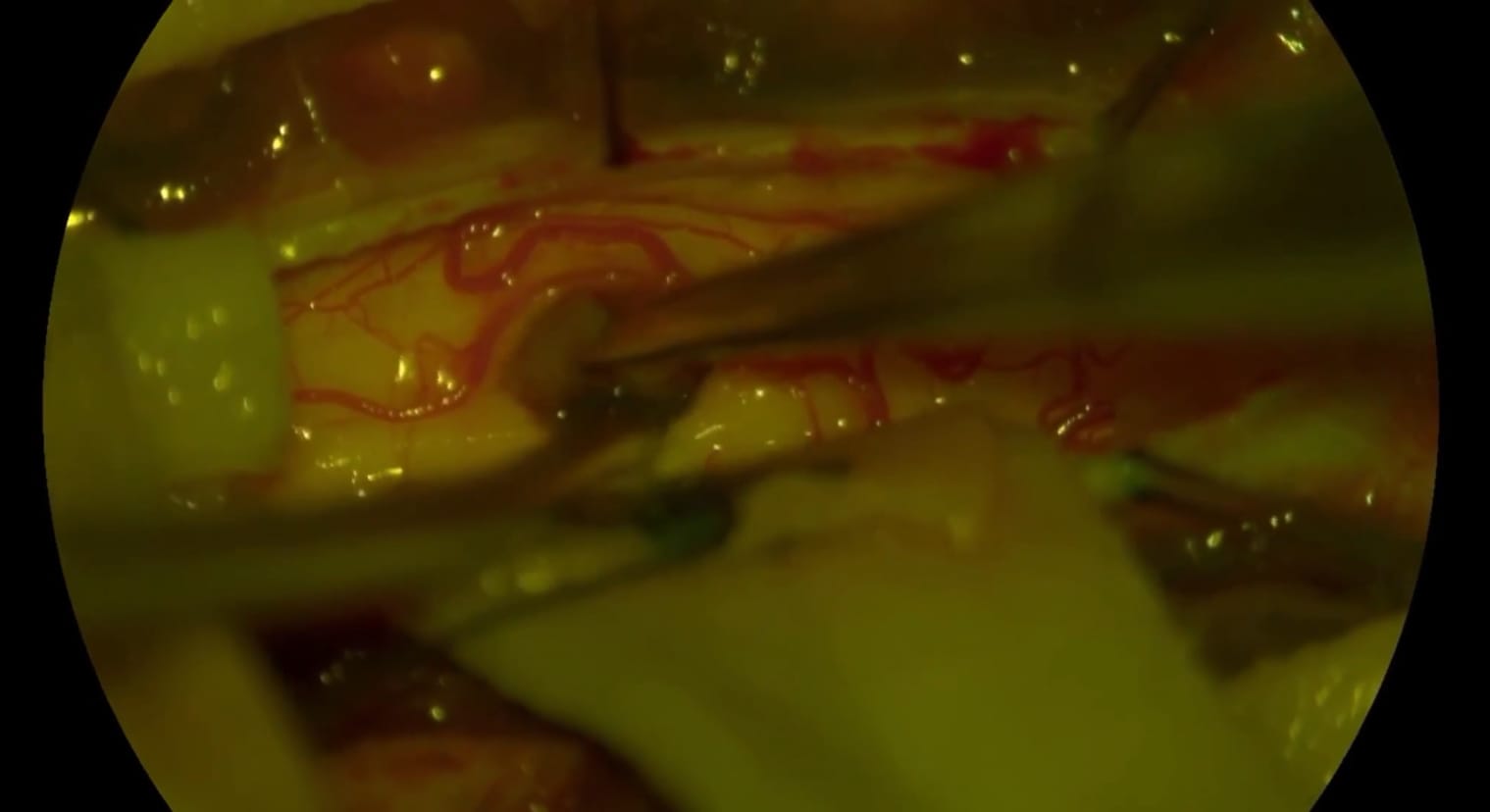 Ependimoma intramedular cervical