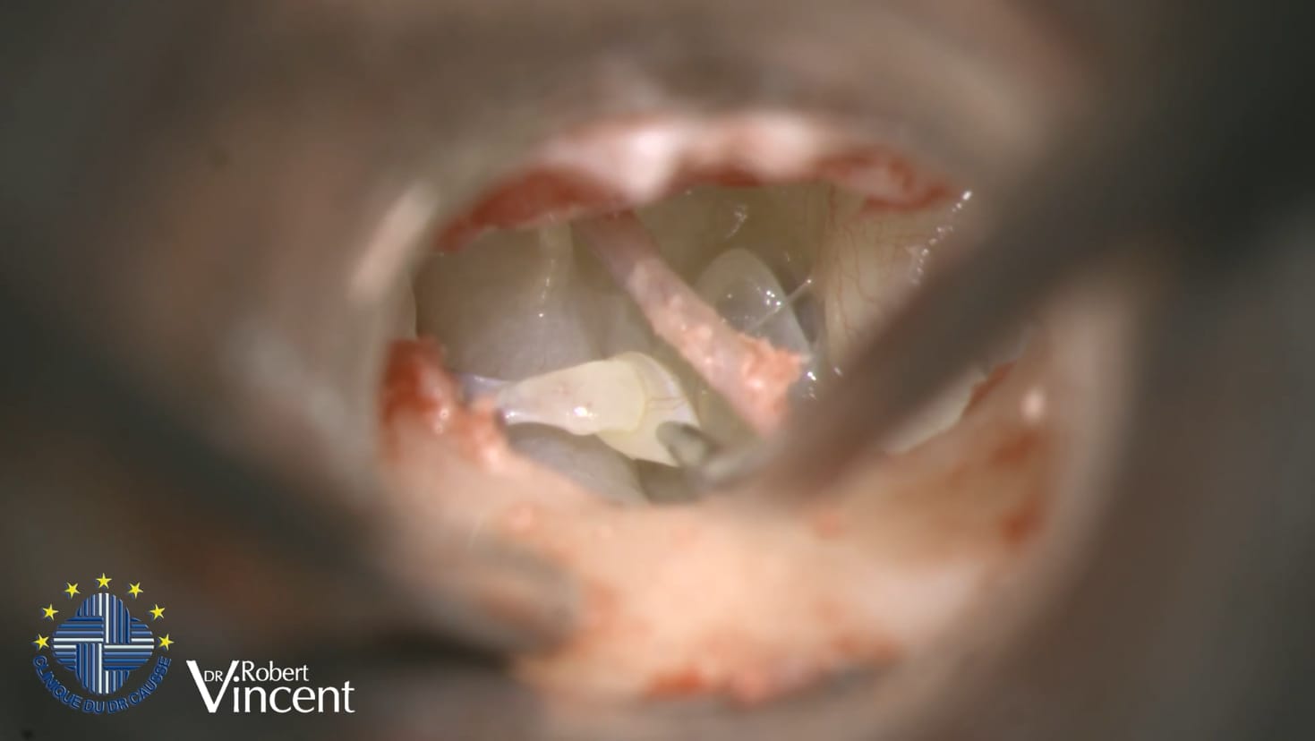 Timpanoplastia compleja