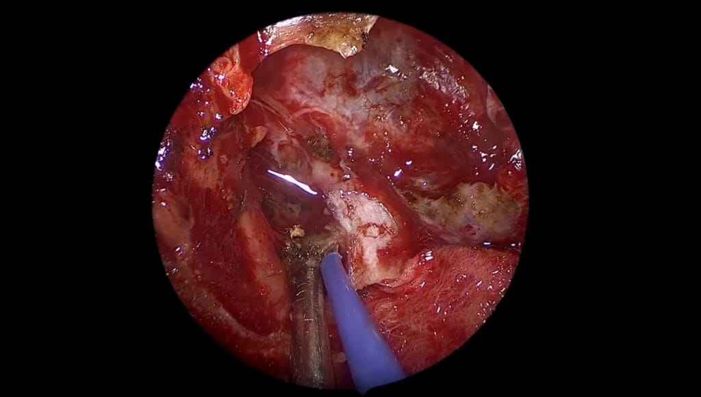 Acromegalia - Destrucción del seno cavernoso