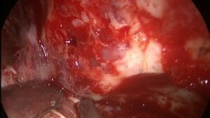 Dehiscencia conducto semicircular superior