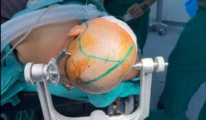 Meningioma clinoidal