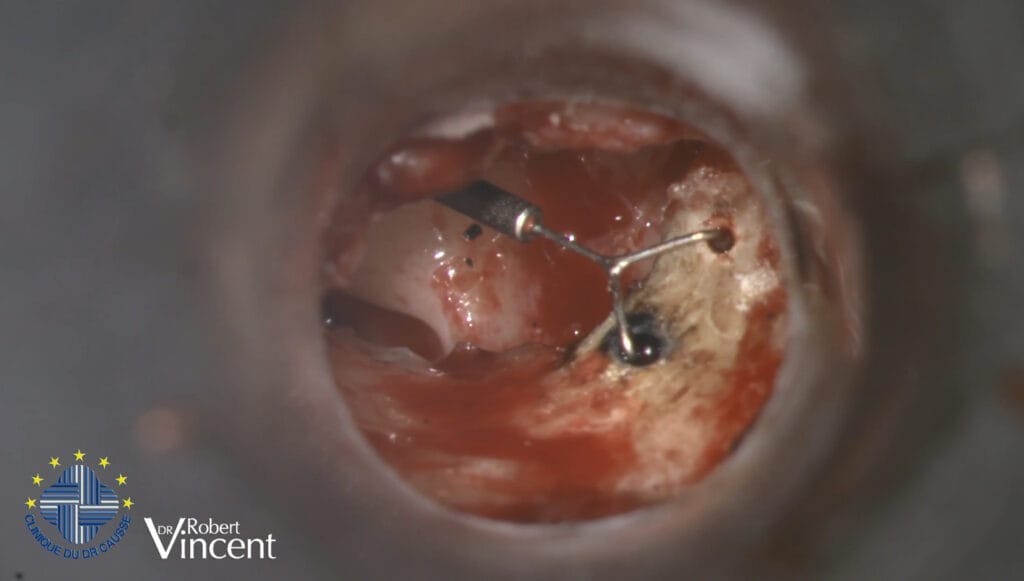 El Dr. Robert Vincent presenta un caso ótico complejo de reconstrucción con prótesis de reemplazo del martillo y TORP.