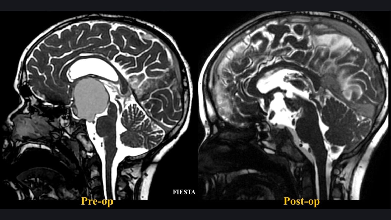 El Dr. Luis Borba realiza la resección microquirúrgica de un craneofaringioma retroquiasmático mediante abordaje petroso posterior modificado